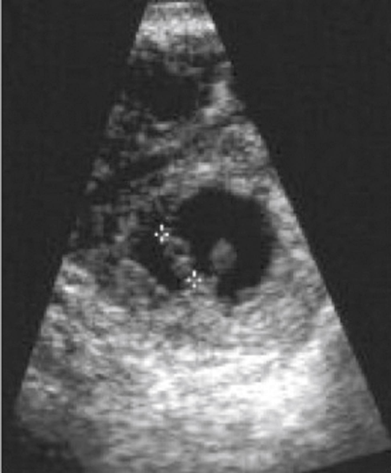 Figure 28.3, Ectopic pregnancy in fallopian tube.