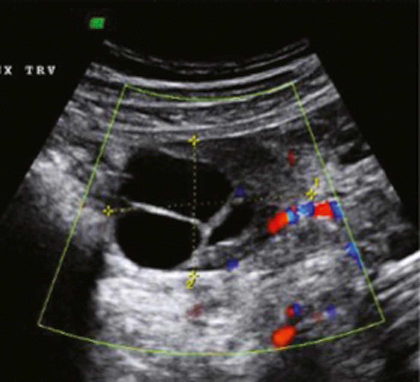 Figure 28.4, Serous cystadenoma.