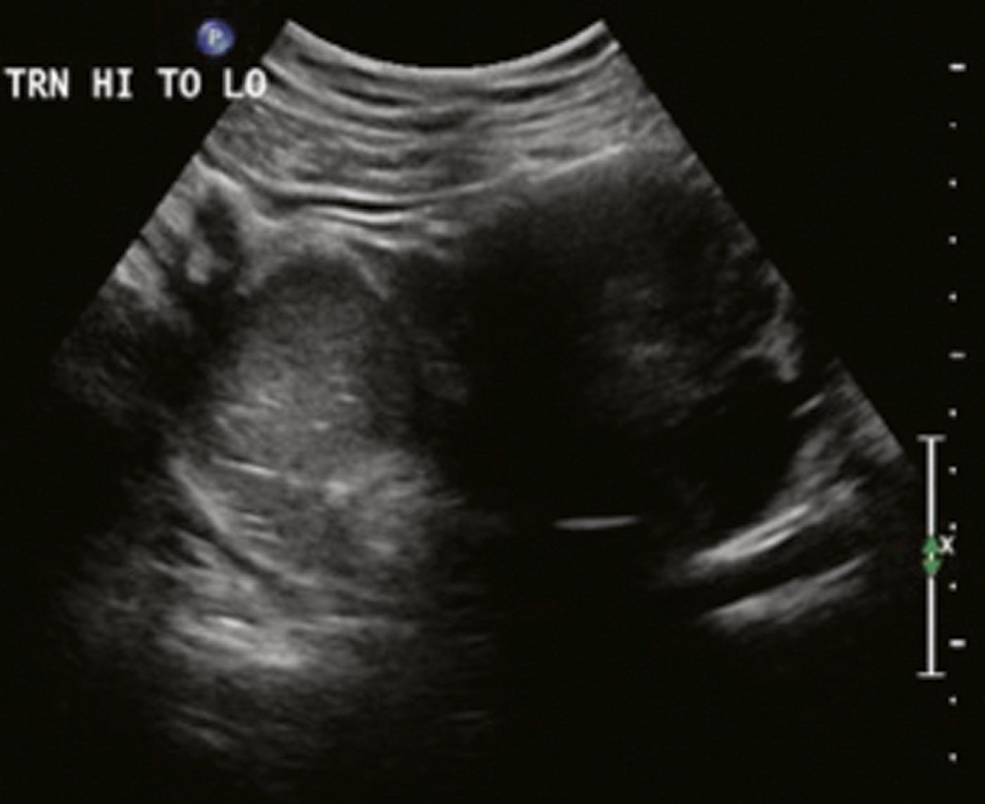 Figure 28.6, Right adnexal mass with complex internal echoes.