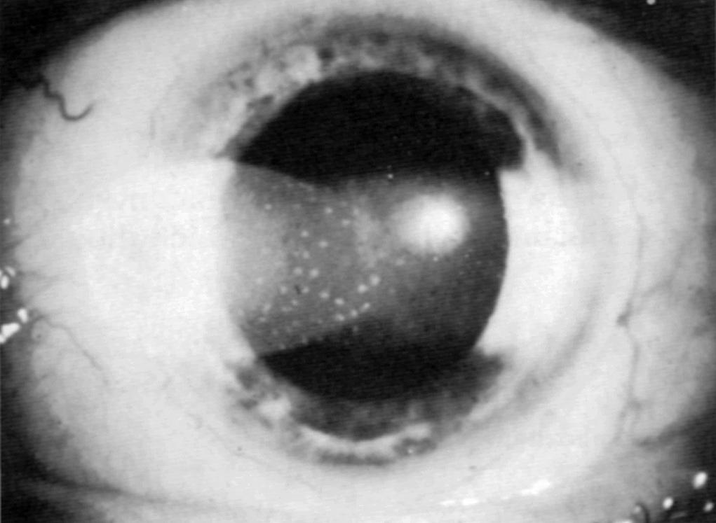 Fig. 22.3, A slit-lamp examination shows “flare” in the fluid of the anterior chamber (caused by increased protein content) and keratic precipitates on the posterior surface of the cornea, representing small collections of inflammatory cells.