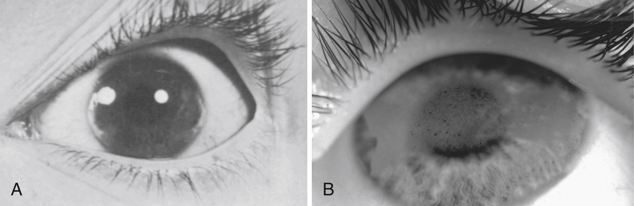 Fig. 22.5, A, Early band keratopathy is noted as a semilunar band just inside the limbus medially and laterally. It does not extend across the pupil. B, The semiopaque band extends across the midplane of the cornea in this example of more advanced band keratopathy.