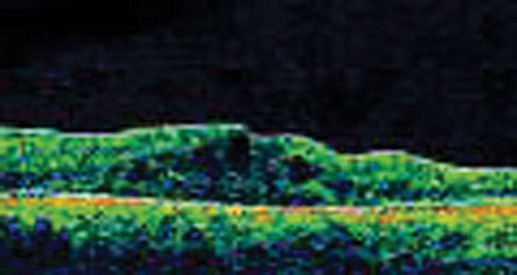 Fig. 22.6, Cystoid macular edema. Optical coherence tomography (OCT) images the retina and its layers by reflectance. The normal macula is concave. The convex appearance of the macula in this example is the result of cystoid edema.
