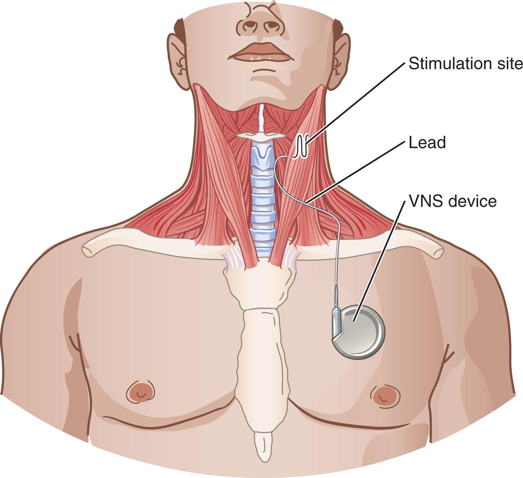 Figure 42.1, Vagal nerve stimulator.