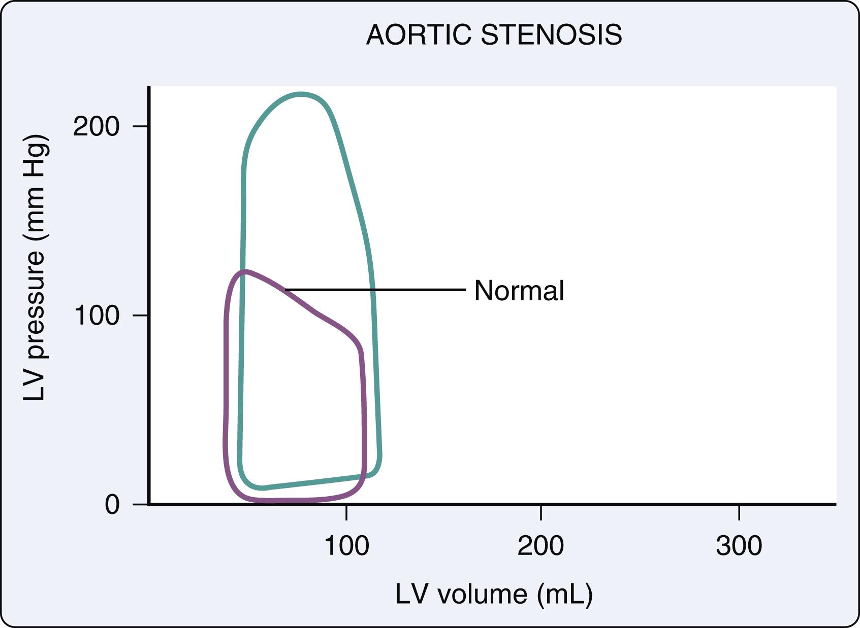 Figure 15.13, Pressure-volume loop (green) in a patient with aortic stenosis and a normal patient (purple) . LV , Left ventricular.