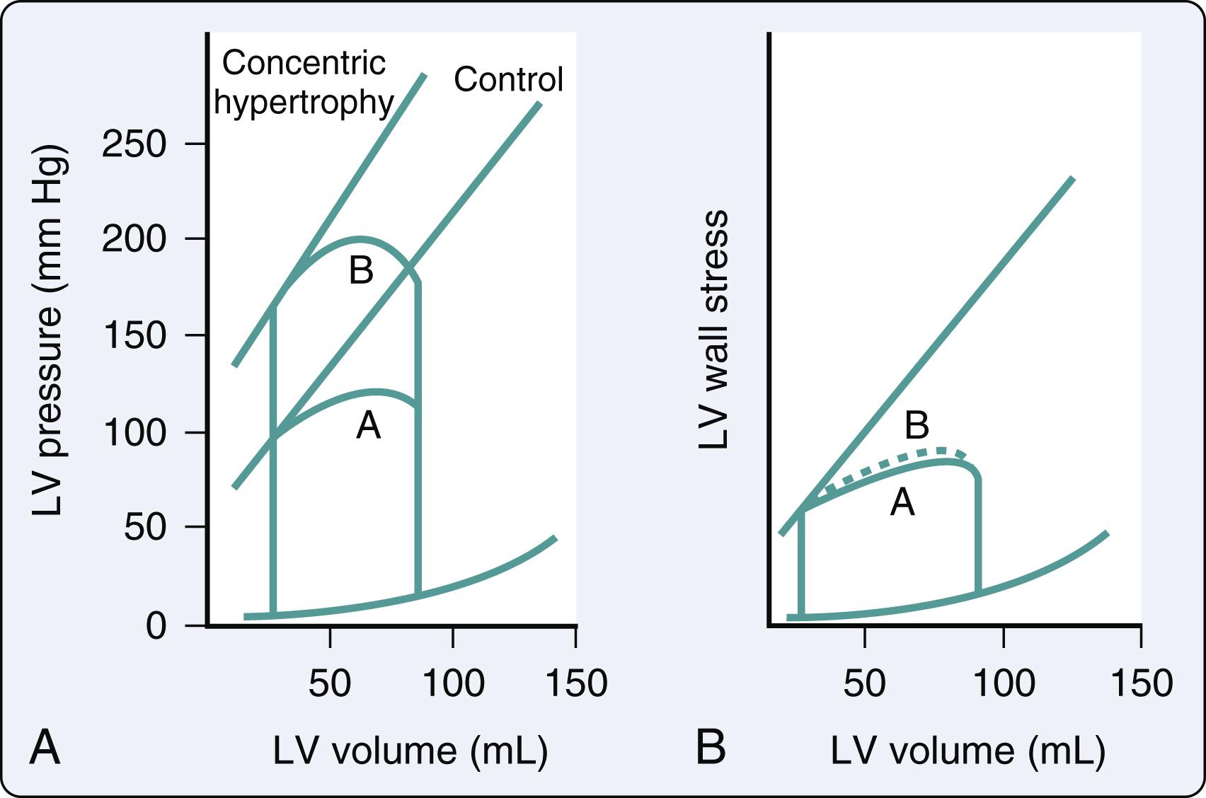 Figure 15.15, Adaptation to pressure overload. (A) Pressure-volume curves and the linear end-systolic pressure-volume relationship before (A) and after (B) the development of concentric hypertrophy. After hypertrophy development, the end-systolic pressure-volume relationship is shifted upward and to the left (ie, apparent supranormal contractility). (B) The same relationships are plotted with stress-volume loops. The loops before (A) and after (B) concentric hypertrophy are essentially the same, reaching the identical end-systolic wall stress–volume point (ie, contractility unchanged). LV , Left ventricular.