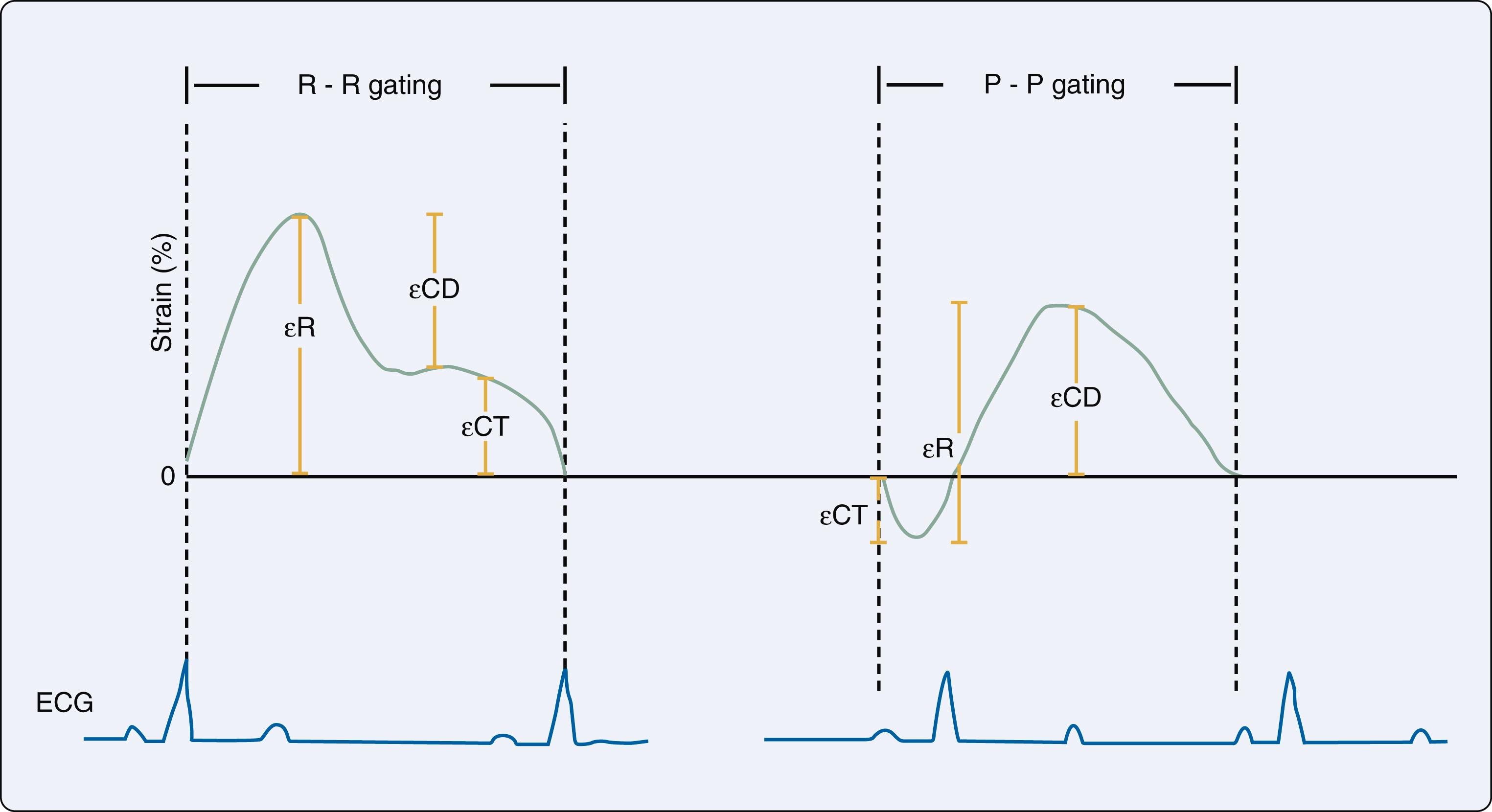 Figure 15.6, Two protocols for left atrial (LA) strain measurement are described depending on the use of the P wave (P-P gating) or the QRS complex (R-R gating) as the initiation of the strain calculation. 14 In R wave gating, all strain values are positive, and there are two peaks that correspond to reservoir function (first peak between R wave and T wave) and atrial contractile function (starting on the P wave); the difference between reservoir strain and atrial contractile strain values reflects conduit function. In P-P gating, the cycle is an asymmetric sinusoidal curve, an initial negative deflection that represents atrial contractile function and a positive peak that represents conduit function; the sum of these equals reservoir strain. With these methods, LA reservoir strain (εR), conduit strain/“early diastolic strain” (εCD), and contractile strain/“late diastolic strain” (εCT) should be interchangeable when viewed as scalar quantities. ECG , Electrocardiogram.