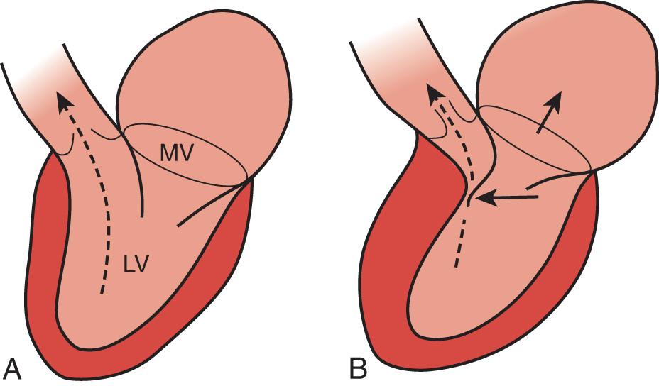 Fig. 15.2, Proposed mechanism of systolic anterior motion in hypertrophic cardiomyopathy. (A) Normally, blood is ejected from the left ventricle (LV) through an unimpeded outflow tract. (B) Thickening of the ventricular septum restricts the outflow tract, and the obstruction causes the blood to be ejected at a higher velocity and closer to the area of the anterior mitral valve (MV) leaflet. Owing to its proximity to the high-velocity fluid path, the anterior MV leaflet is drawn toward the hypertrophied septum by a Venturi effect (left arrow) .