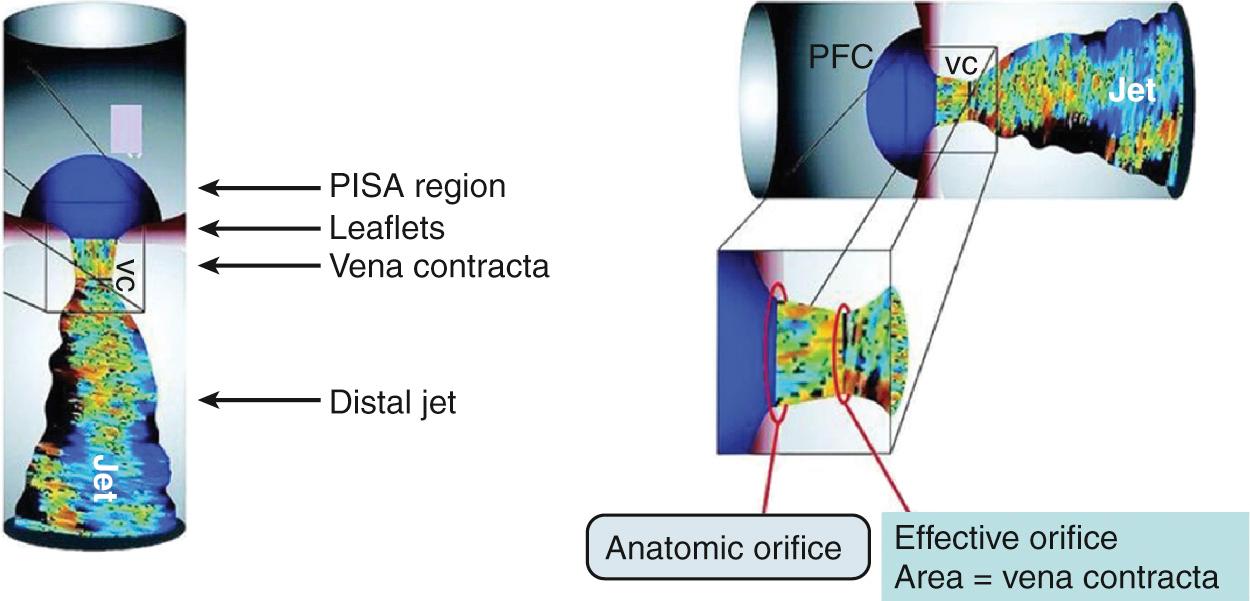 Fig. 12.1, The three components of a regurgitant jet.