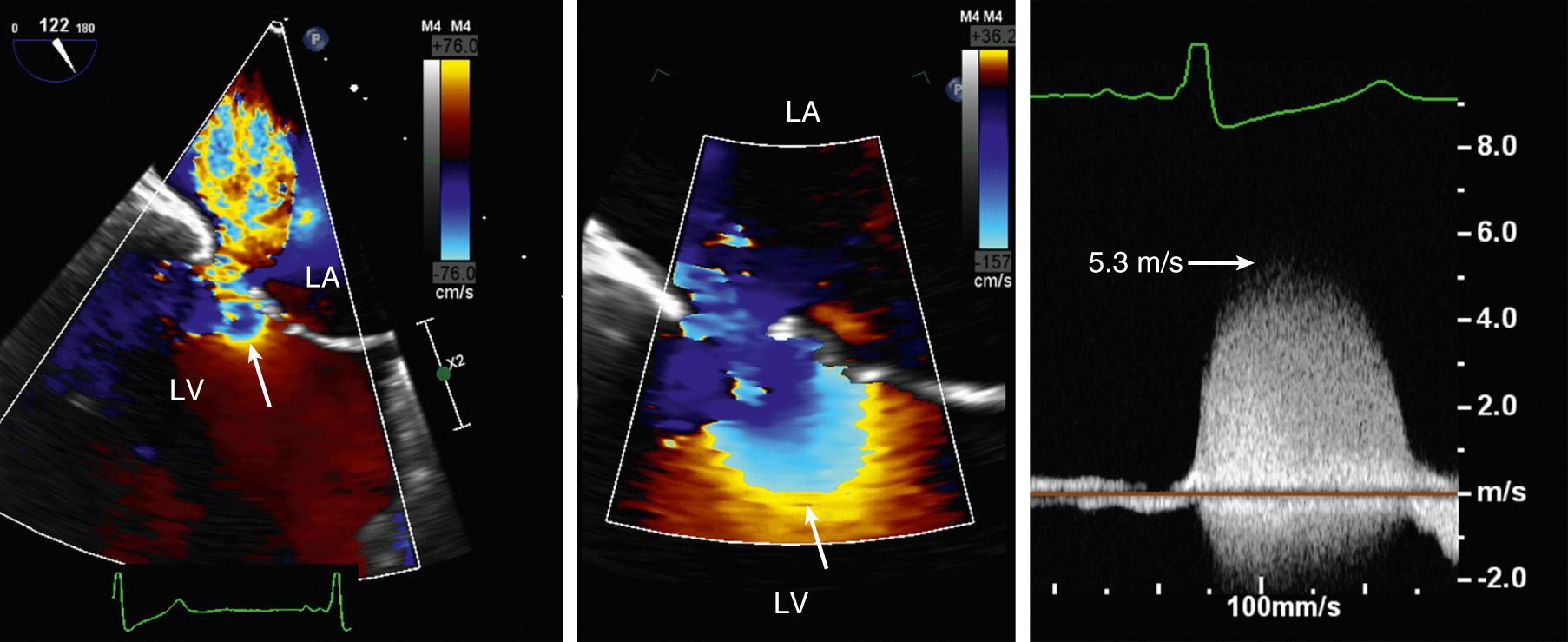 Fig. 12.11, Proximal isovelocity surface area imaging.