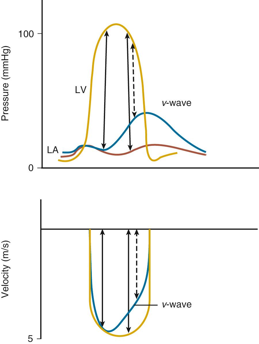Fig. 12.12, Pressure-velocity relationships for mitral regurgitation.