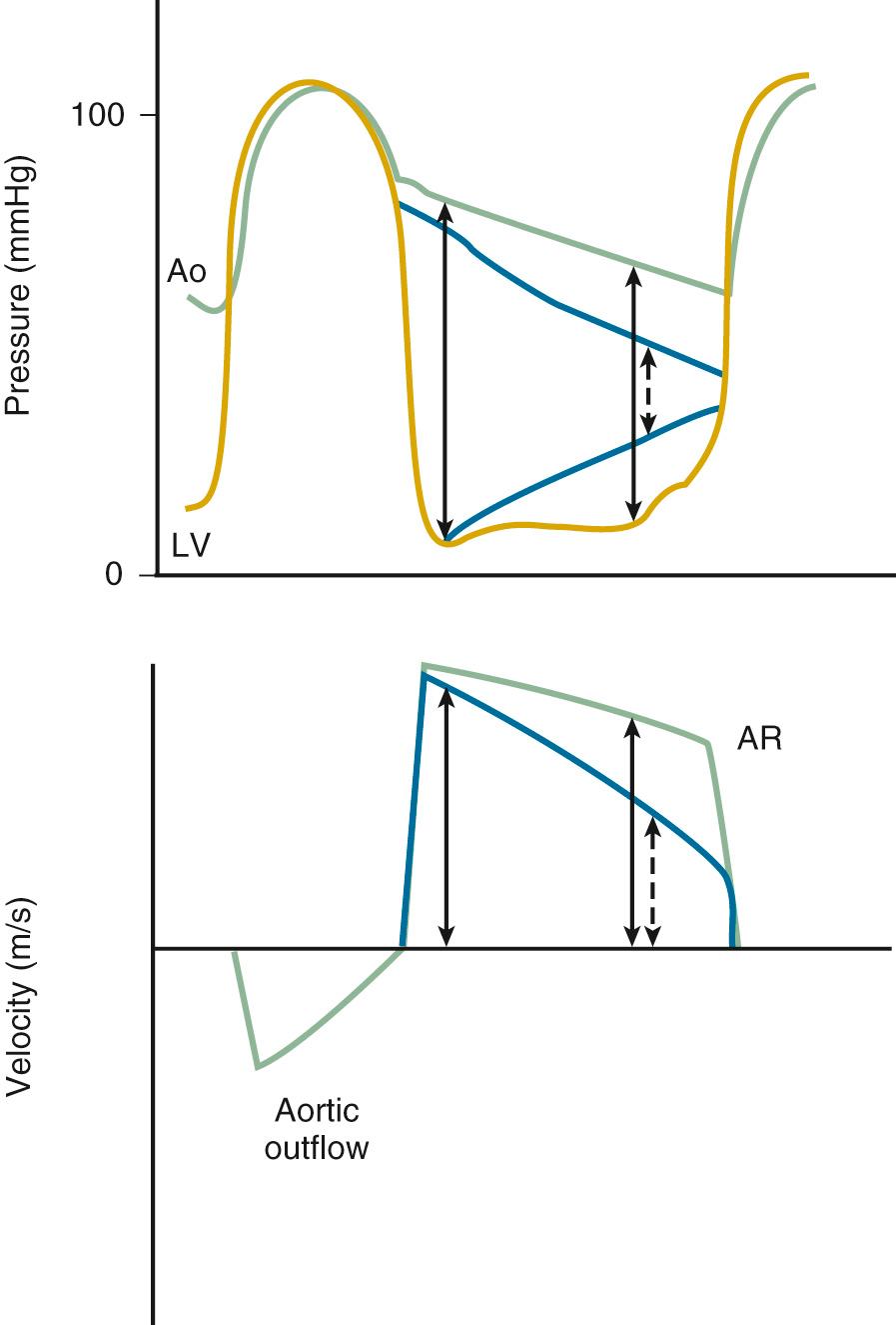 Fig. 12.13, Pressure-velocity relationships for aortic regurgitation.