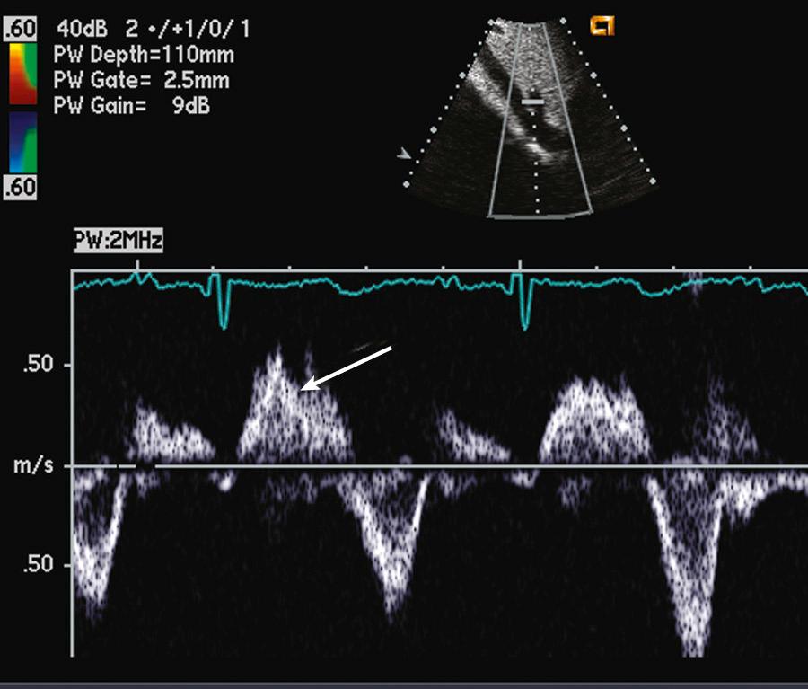 Fig. 12.14, Hepatic vein systolic flow reversal with severe tricuspid regurgitation and normal sinus rhythm.