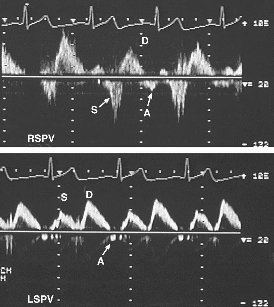 Fig. 12.15, Pulmonary vein systolic flow reversal with severe mitral regurgitation and normal sinus rhythm.
