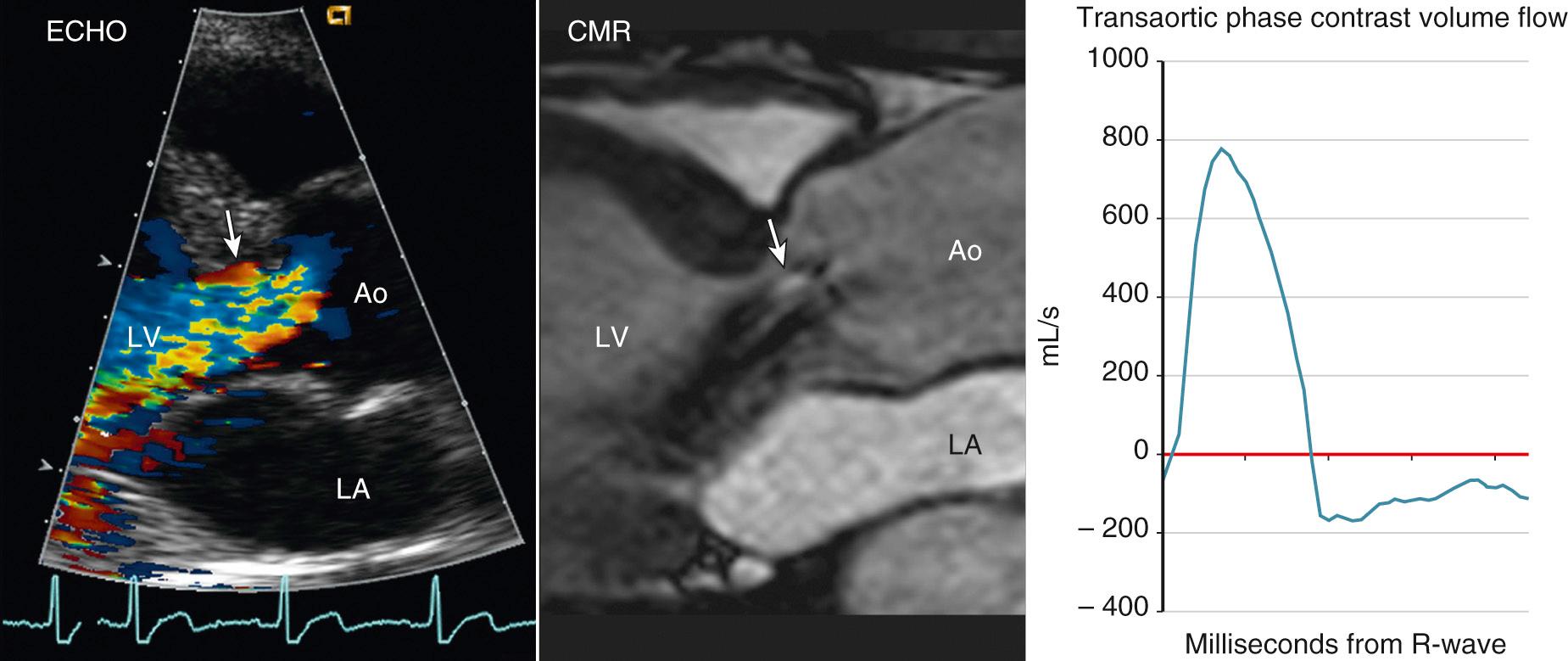 Fig. 12.17, Cardiac magnetic resonance imaging for quantitation of aortic regurgitation.