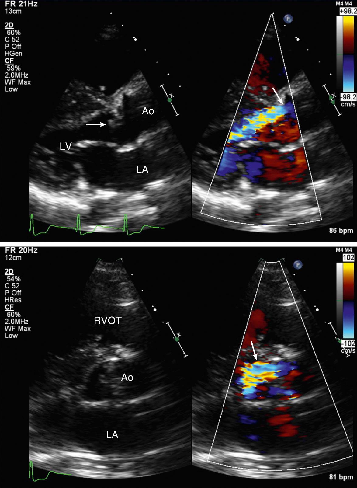 Fig. 12.18, Acute aortic regurgitation.