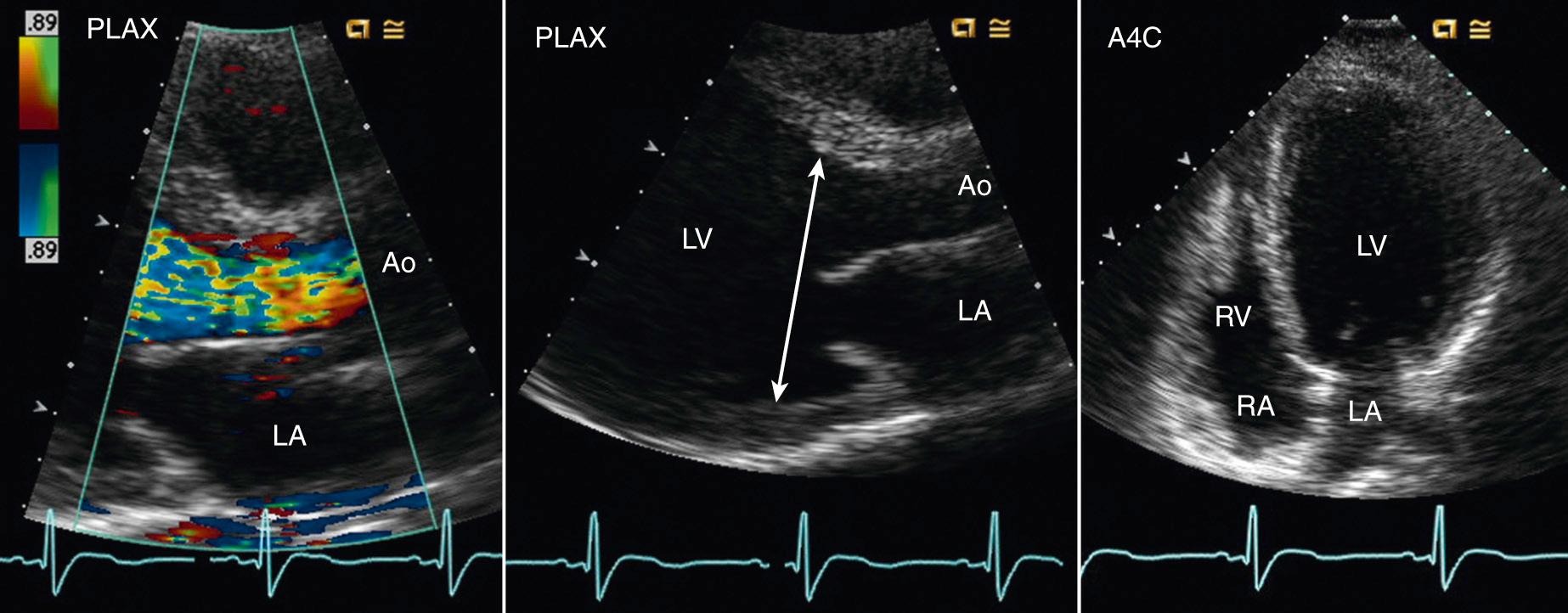 Fig. 12.19, Left ventricle dilation and increased sphericity with chronic severe aortic regurgitation.