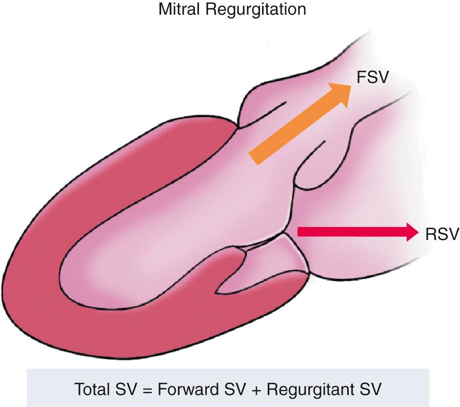 Fig. 12.2, Total, forward, and regurgitant stroke volume.