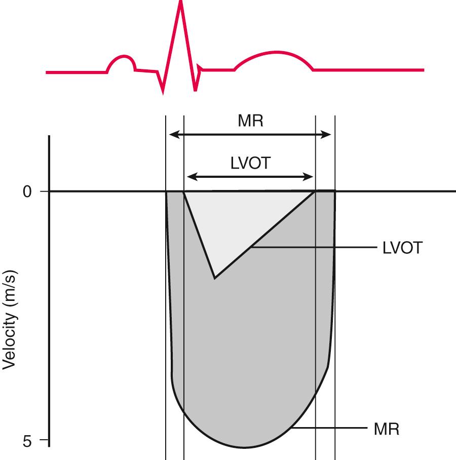 Fig. 12.3, Relative timing of mitral regurgitation and left ventricular outflow tract flow signals.