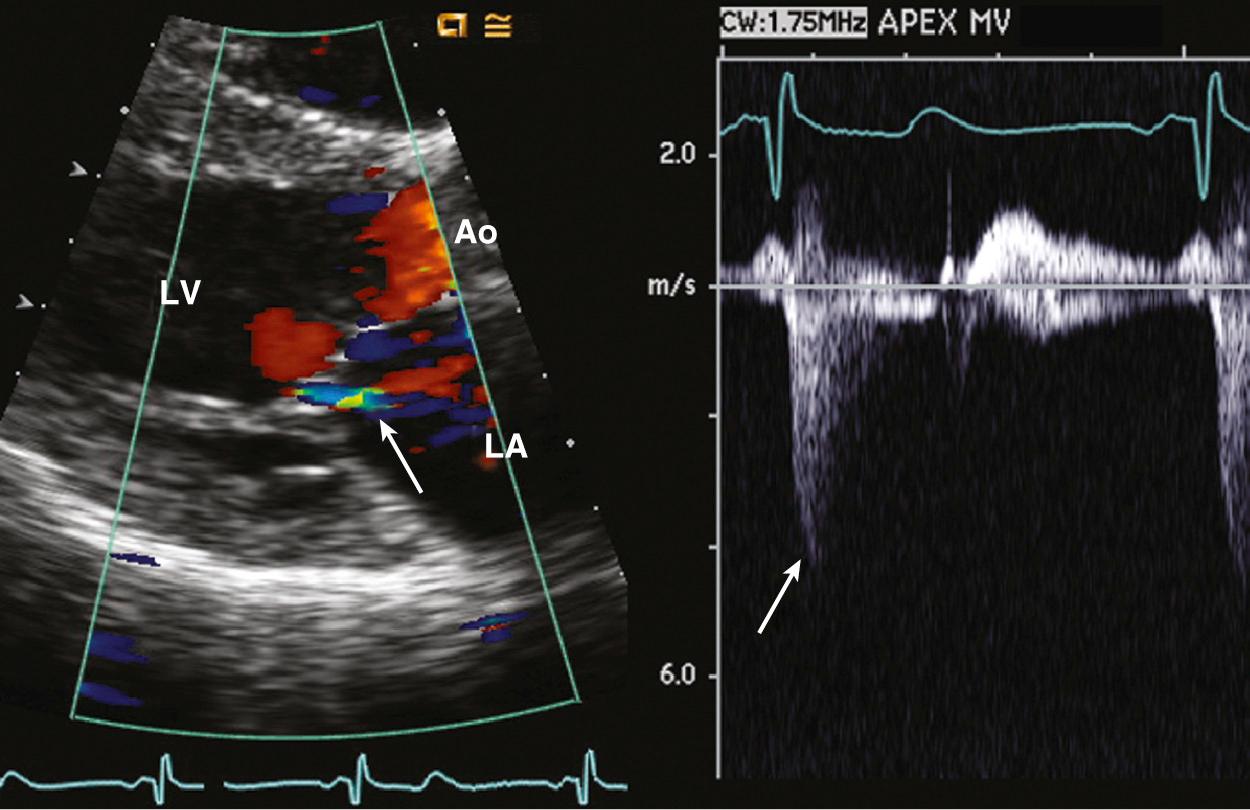 Fig. 12.4, Normal mitral regurgitation.