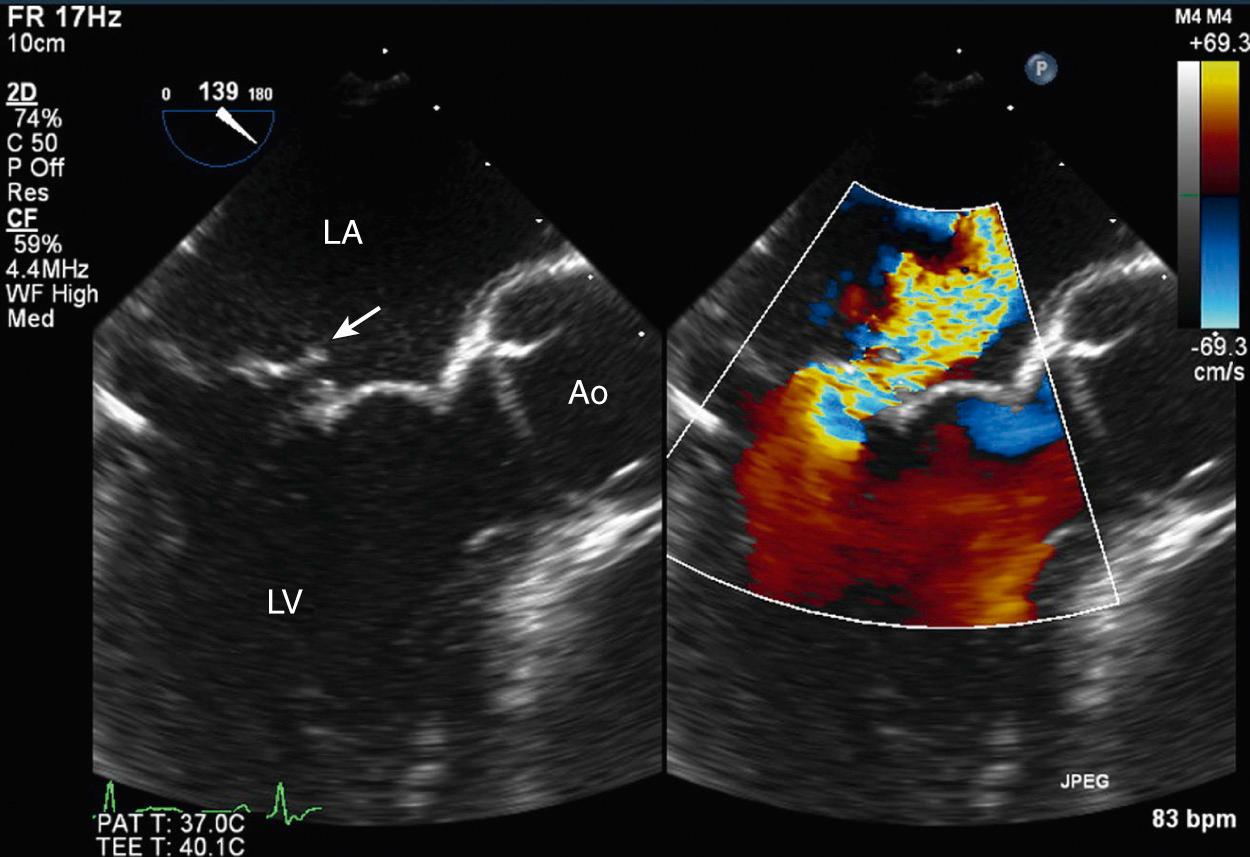 Fig. 12.5, Anteriorly directed mitral regurgitation on transesophageal echocardiography.