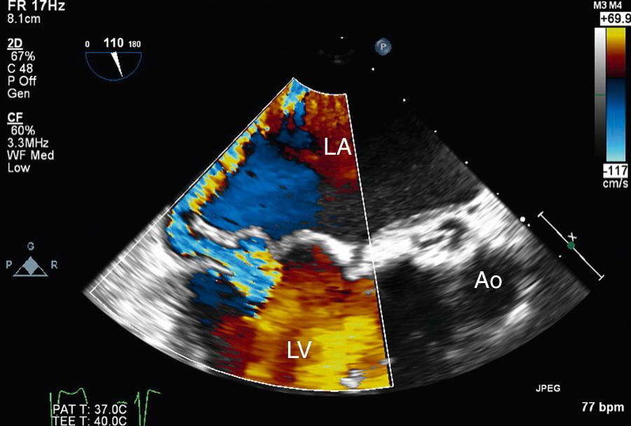 Fig. 12.6, Posteriorly directed mitral regurgitation on transesophageal echocardiography.