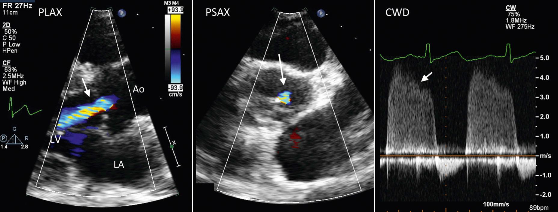 Fig. 12.7, Mild aortic regurgitation.