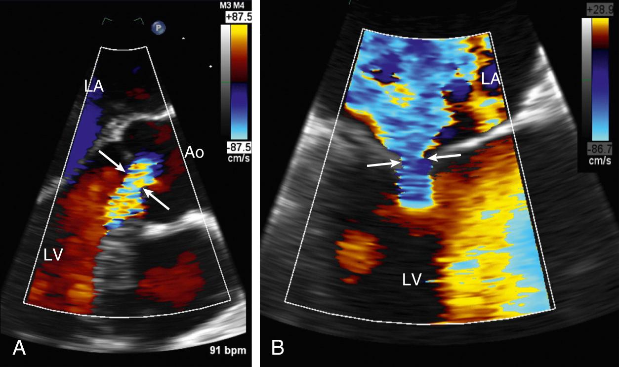 Fig. 12.8, Vena contracta measurement.