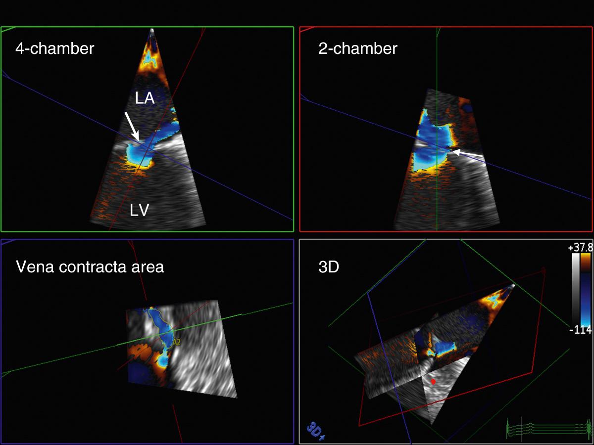 Fig. 12.9, 3D color Doppler vena contracta imaging.