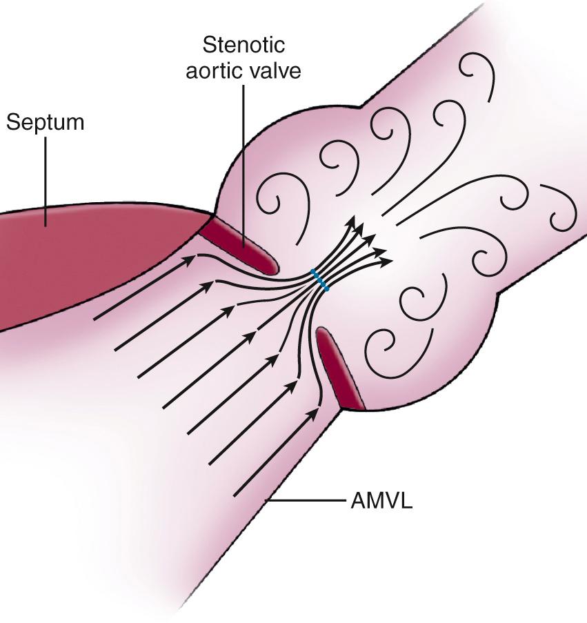 Fig. 11.1, Fluid dynamics of the stenotic aortic valve.