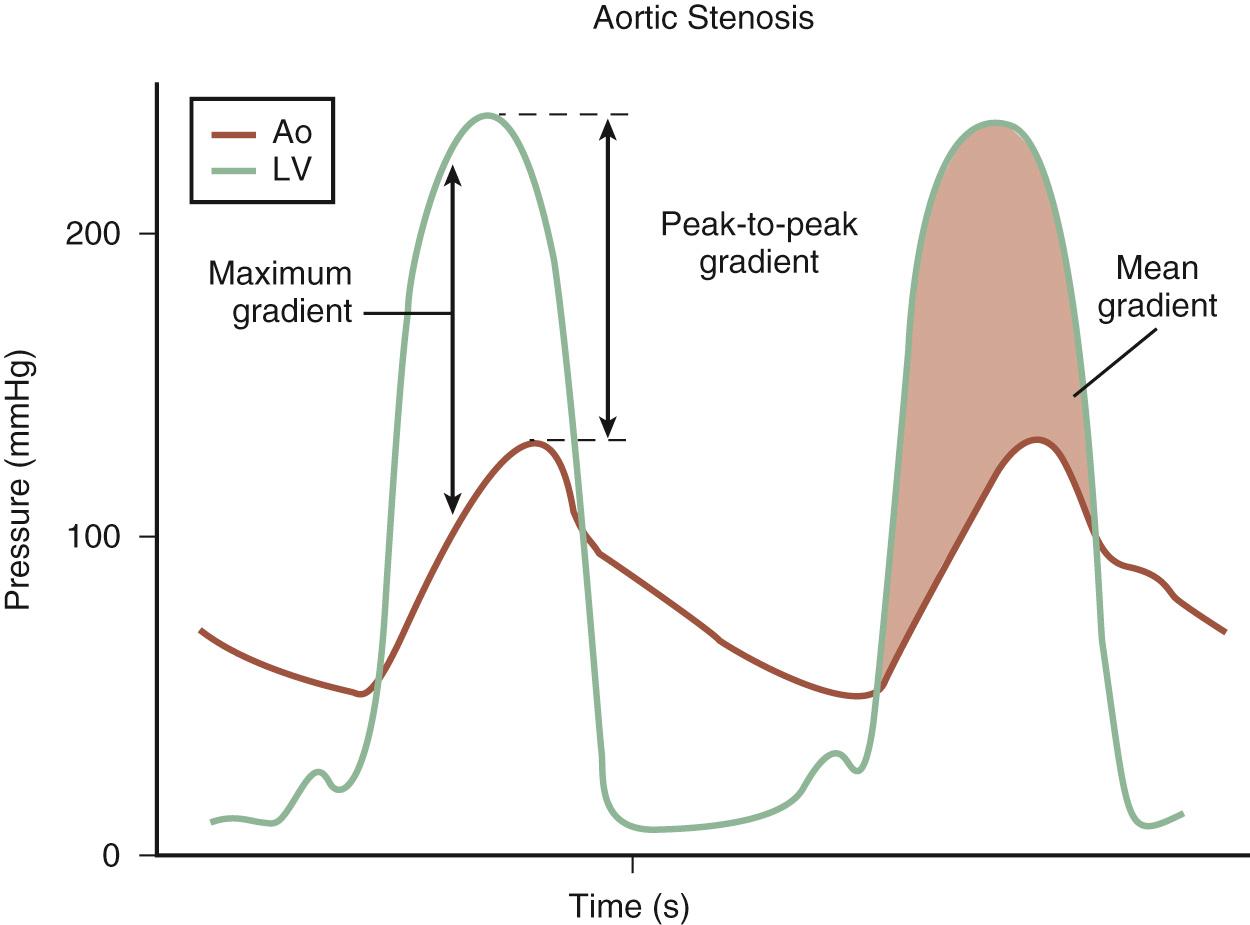 Fig. 11.11, Left ventricular and aortic pressures in aortic valve stenosis.