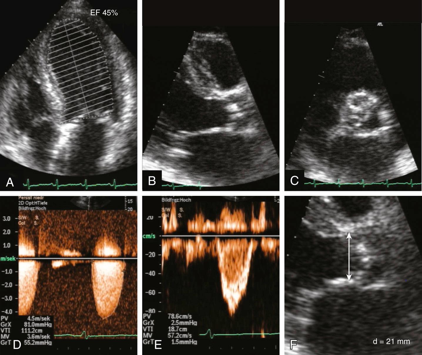 Fig. 11.13, Assessment of aortic stenosis severity.