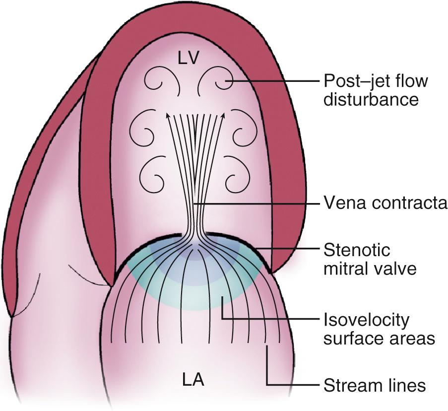 Fig. 11.4, Fluid dynamics of rheumatic mitral stenosis.