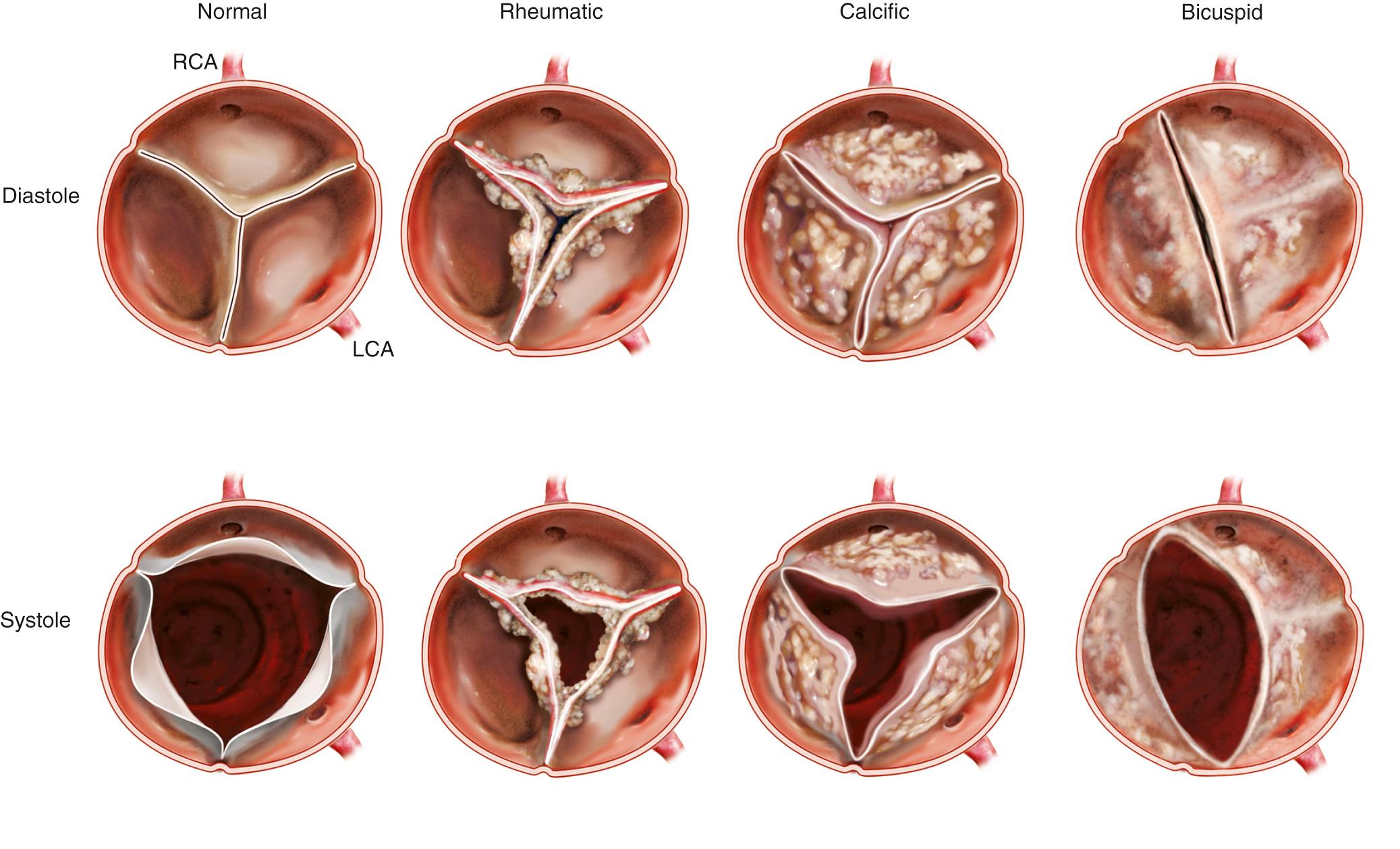 Fig. 11.5, Causes of aortic stenosis.