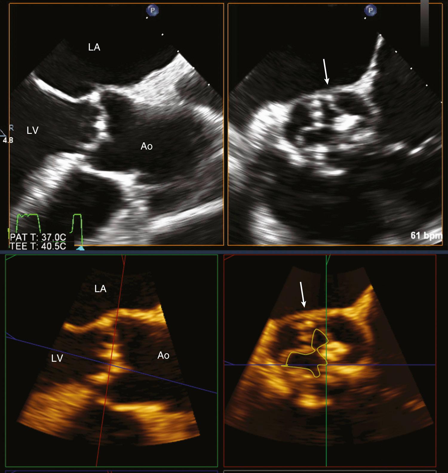 Fig. 11.6, 2D and 3D transesophageal echocardiography of calcific aortic stenosis.