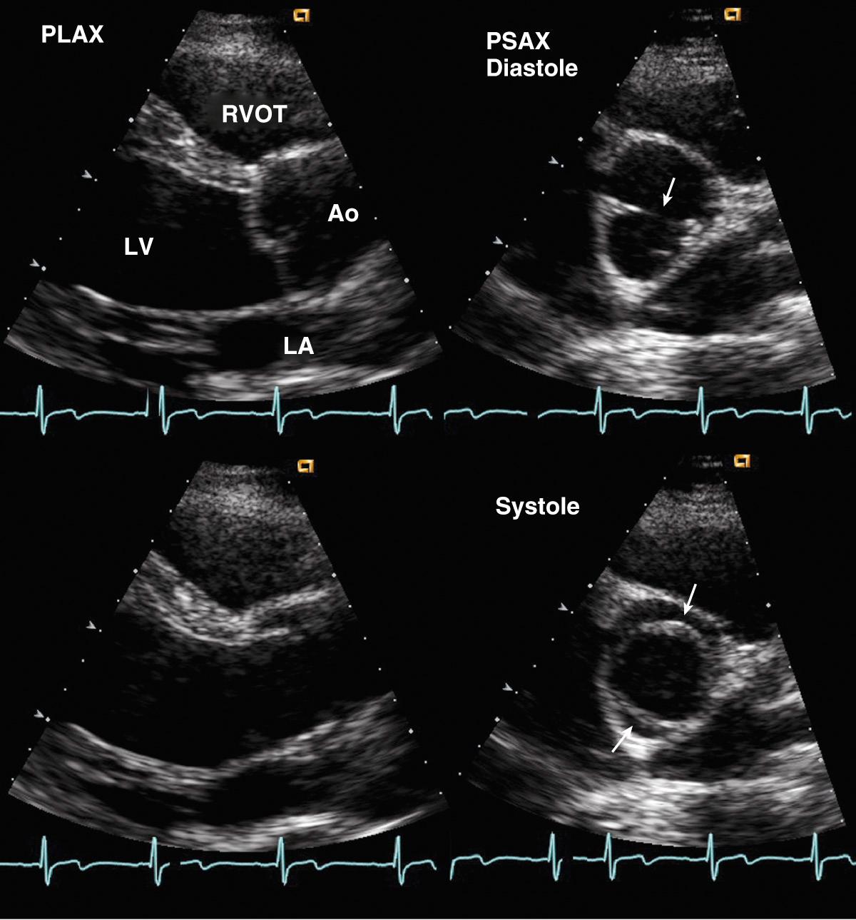 Fig. 11.7, Bicuspid aortic valve.