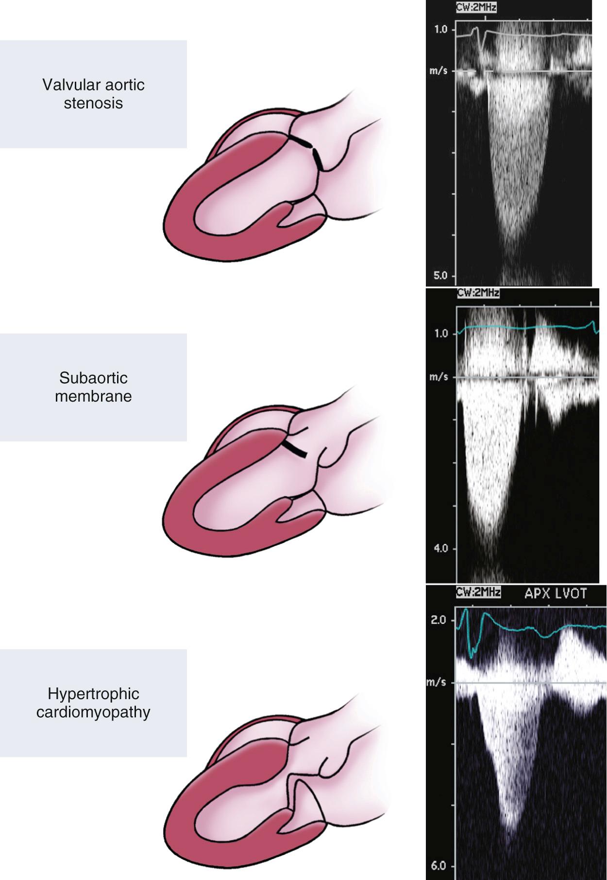 Fig. 11.9, Different types of left ventricular outflow obstruction.