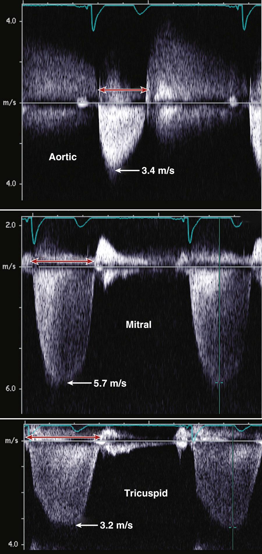 Fig. 11.10, Correct identification of the aortic jet.