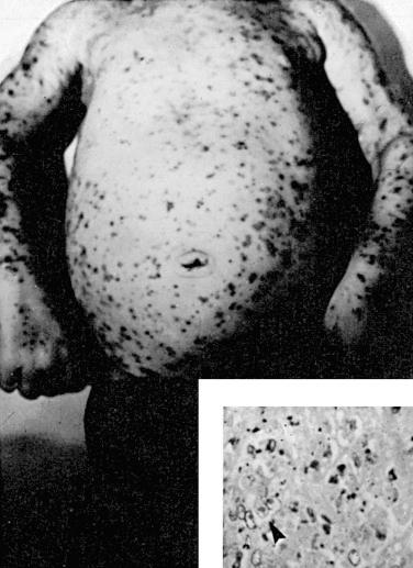 Figure 23-1, Congenital hemorrhagic varicella complicated by pneumonia and hepatitis. The mother of this infant developed varicella a few days before delivery. Zoster immunoglobulin was unavailable at that time. Inset shows section of liver with intranuclear inclusion bodies obtained at autopsy.