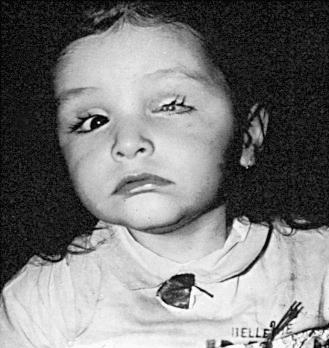 Figure 23-4, A child, whose mother had varicella during the 16th week of pregnancy, had atrophy of the left orbit, with blindness that required cosmetic enucleation. Severe chorioretinitis occurred in the right eye. Except for blindness, the child developed normally. She died of pneumonia when approximately 4 years of age.