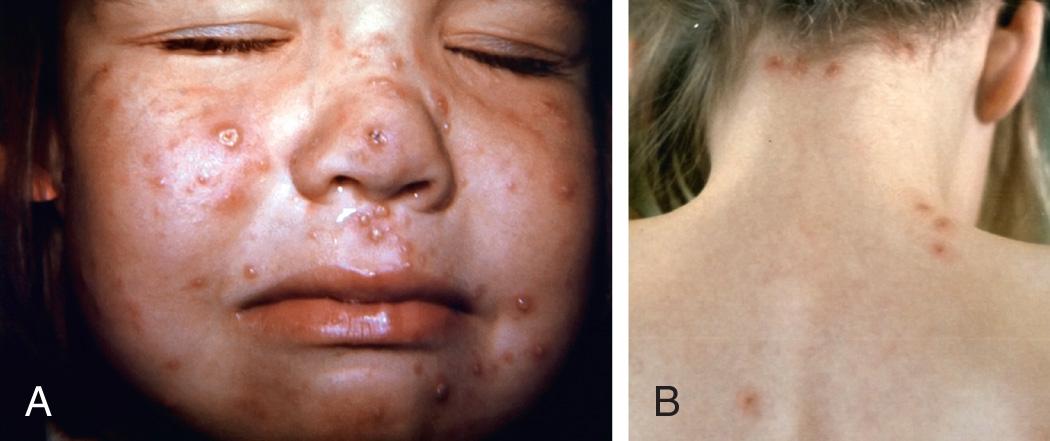 Fig. 280.1, A, Varicella lesions in unvaccinated persons display the characteristic “cropping” distribution, or manifest themselves in clusters; the simultaneous presence of lesions in various stages of evolution is characteristic. B, Breakthrough varicella lesions are predominantly maculopapular, and vesicles are less common; the illness is most commonly mild with <50 lesions.