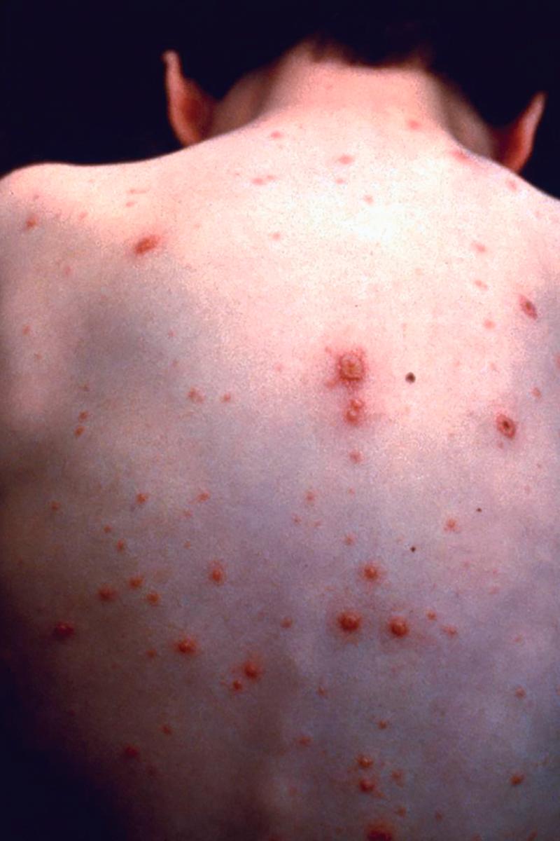 FIGURE 346-1, Child with varicella.