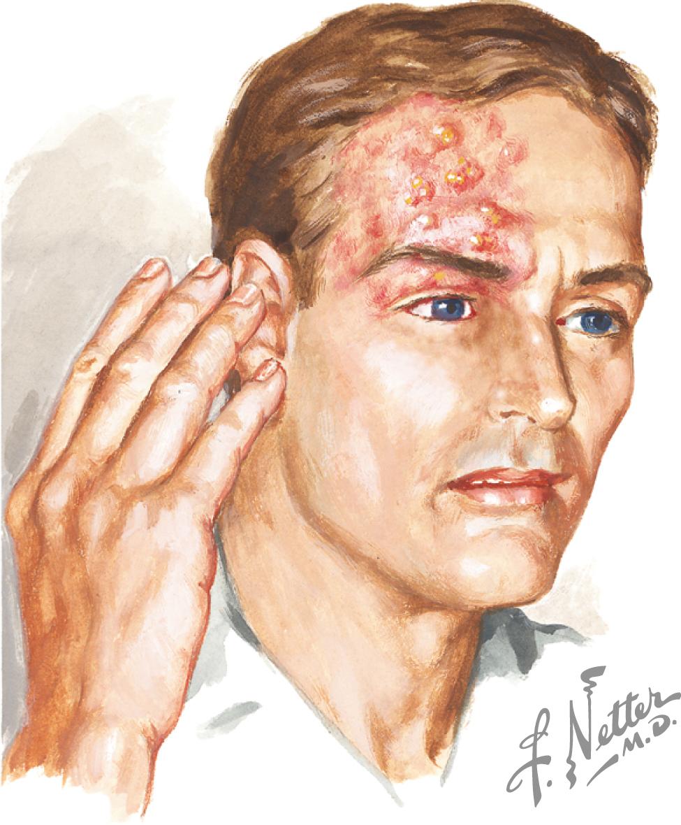 Fig. 13.2, Zoster in the ophthalmic branch of the trigeminal nerve.