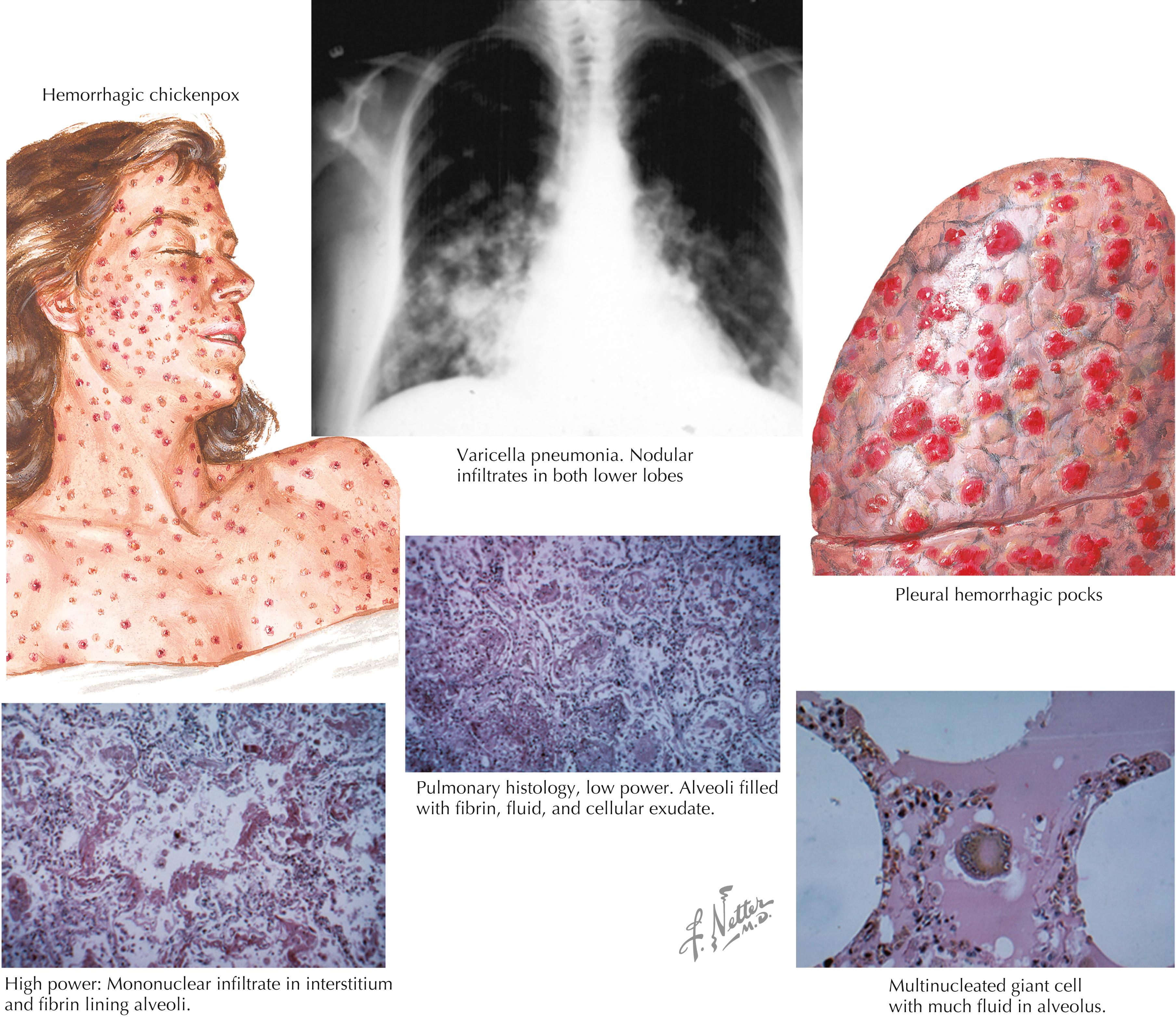 Fig. 13.3, Varicella pneumonia.