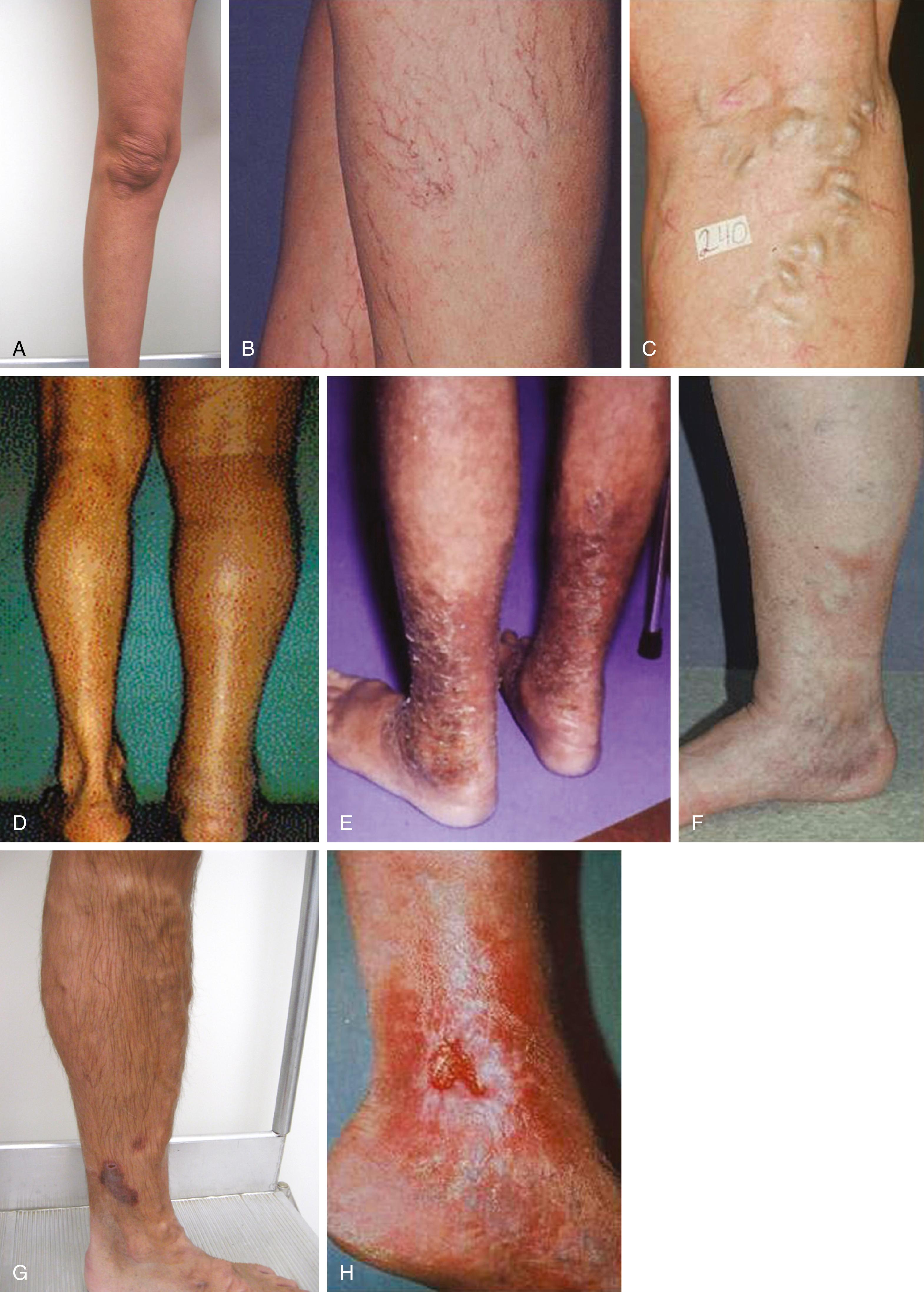 Figure 155.1, CEAP Clinical Classification Representative Images. ( A ) C 0 : No visible or palpable signs of venous disease. ( B ) C 1 : Telangiectasias or reticular veins. ( C ) C 2 : Varicose veins or C 2r : Recurrent varicose veins. ( D ) C 3 : Edema. ( E ) C 4a : Pigmentation or eczema. ( F ) C 4b : Lipodermatosclerosis (pictured) or atrophie blanche. ( G ) C 5 : Healed venous ulcer. ( H ) C 6 : Active venous ulcer or C 6r : Recurrent active venous ulcer.