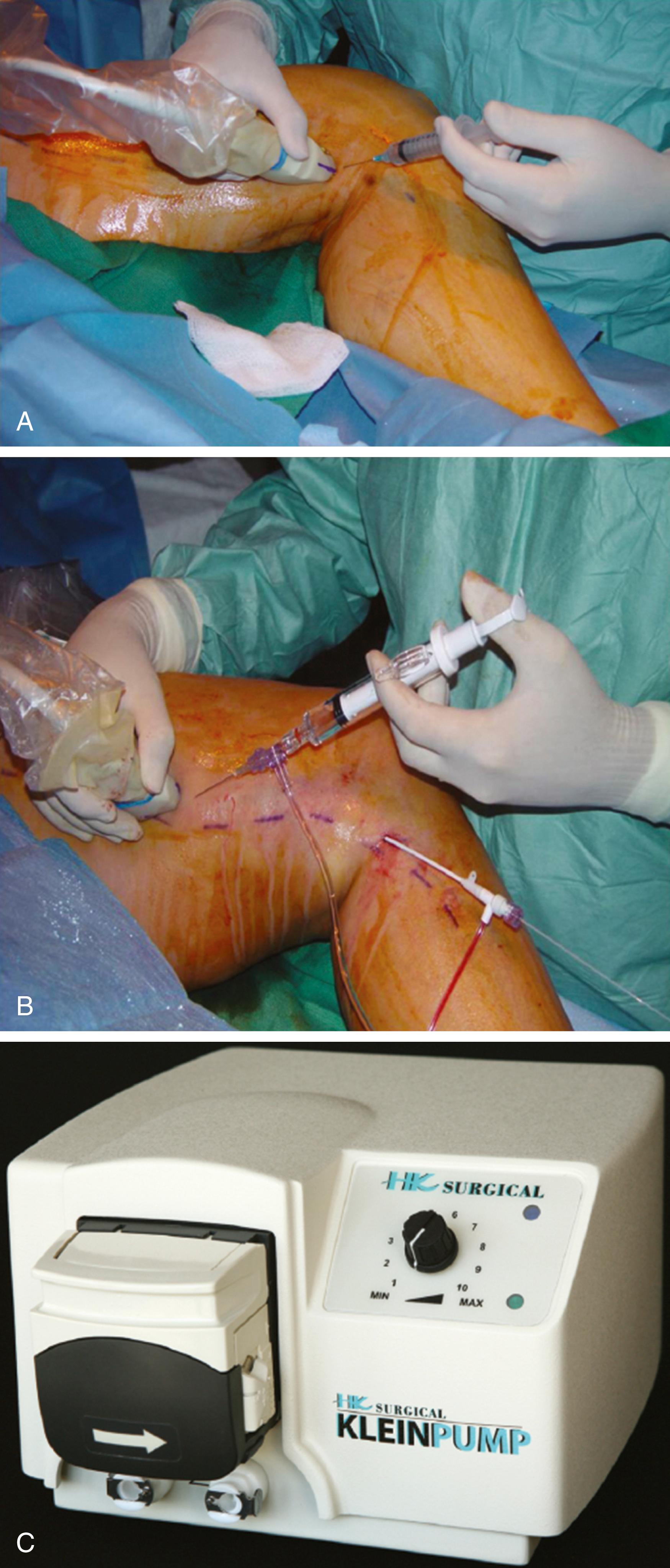 Figure 155.3, ( A ) Delivery of tumescent anesthesia with the hand injection method. ( B ) Delivery of tumescent anesthesia with a refillable syringe. ( C ) HK Klein tumescent pump (HK Surgical Inc., San Clemente, CA).