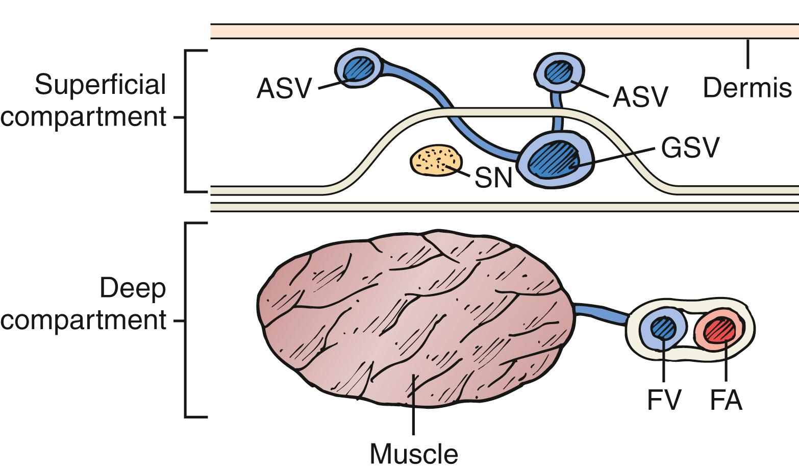 Figure 154.1, The saphenous compartment is bounded by deep and superficial layers of fascia. Tributaries to the saphenous vein pierce the superficial fascia, and it is they that become varicose. ASV , accessory saphenous vein; FA , femoral artery; FV , femoral vein; GSV , great saphenous vein; SN , saphenous nerve.