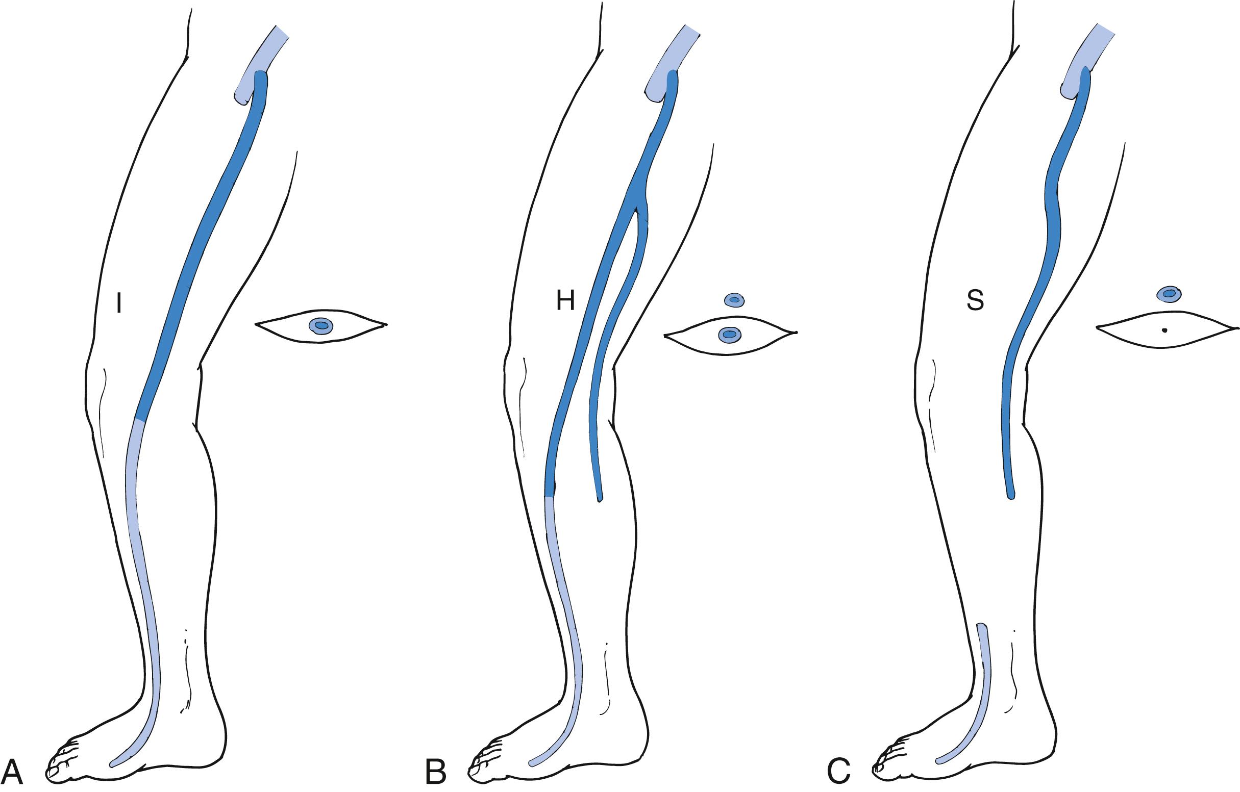 Figure 154.2, Anatomic types of the great saphenous vein (GSV) with respect to the fascial envelope. ( A ) I type. The GSV is present within the fascial envelope along its entire length. ( B ) H type. There is a subcutaneous collateral running parallel and superficial to the main saphenous trunk (left). ( C ) S type. The caudal portion of the GSV in the thigh is atretic, and the extrafascial tributary is dominant.