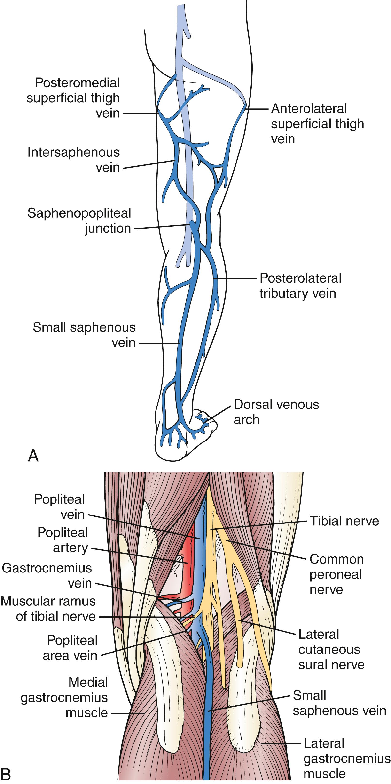 Figure 154.3, ( A ) The small saphenous vein dominates the posterolateral superficial venous drainage and originates in the dorsal venous arch. At the posterolateral aspect of the ankle, it is intimately associated with the sural nerve. Note the important posterolateral tributary vein and the posterior thigh vein, which ascend and connect the small saphenous venous system with the GSV. The anterolateral superficial thigh vein and the posterolateral tributary vein can be very important in congenital venous anomalies, such as Klippel–Trénaunay syndrome. ( B ) The most common neurovascular configuration of the popliteal fossa, although the site of anastomosis is highly variable.