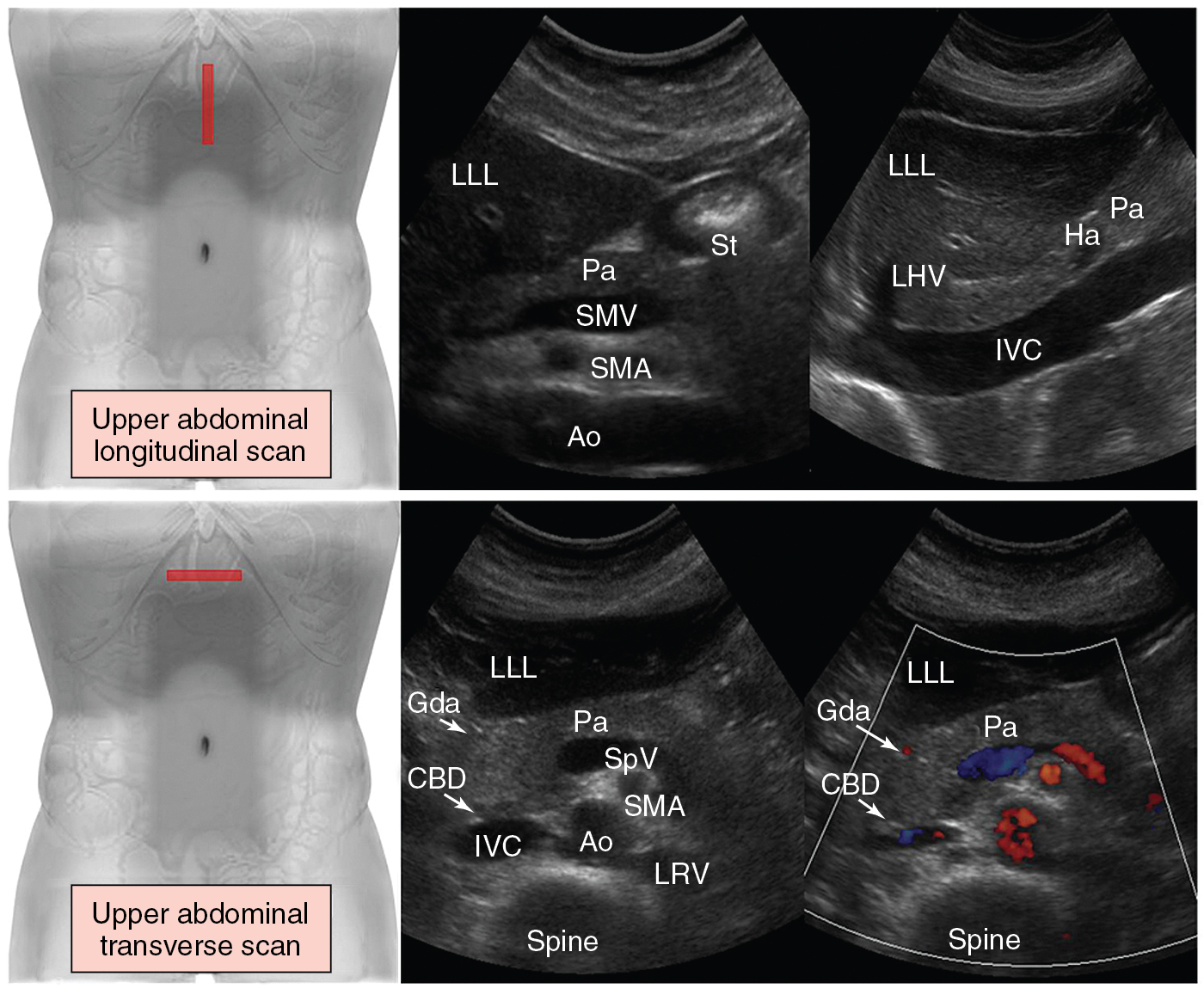 Figure 41 E-1, ( Top ) Upper abdominal scan. Longitudinal views of the structures that are visualized from anterior to posterior are presented: left liver lobe, pancreas, and midabdominal vessels. The aorta and superior mesenteric artery (arising from the aortic anterior wall) are visualized toward the midline ( left ). By sweeping the transducer slightly to the right, the inferior vena cava is visualized ( right ). ( Bottom ) Transverse views. The transducer is angled inferiorly by using the left liver lobe as an acoustic window to image the pancreas and midabdominal vessels. The aorta and splenic vein crossing over the superior mesenteric artery are used as landmarks to identify the pancreas. The gastroduodenal artery and common bile duct assist in outlining the lateral margin of the head of the pancreas. Ao , Aorta; CBD , common bile duct; Gda , gastroduodenal artery; Ha , hepatic artery; IVC , inferior vena cava; LHV , left hepatic vein; LLL , left liver lobe; LRV , left renal vein; Pa , pancreas; SMA , superior mesenteric artery; SMV , superior mesenteric vein; SpV , splenic vein; St , stomach (gastric antrum).