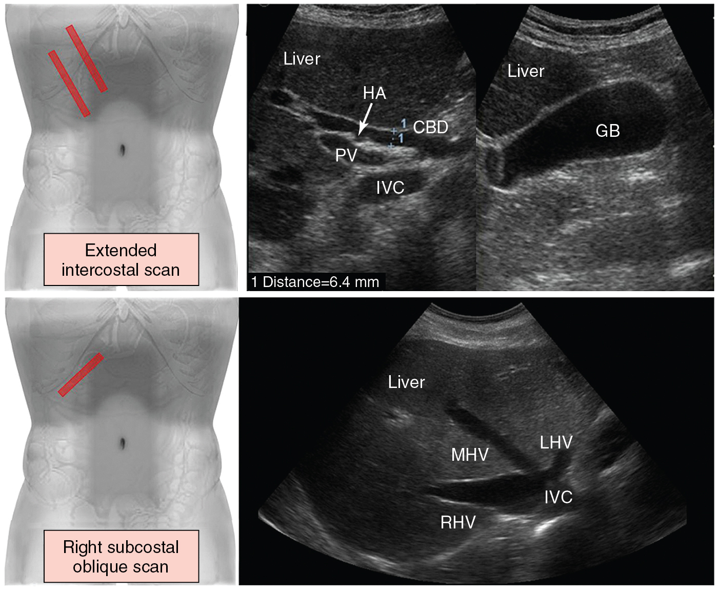 Figure 41 E-2, ( Top ) Extended intercostal scan. The transducer is oriented longitudinally and lateral to the midline in an intercostal space or below the costal arch. In the porta hepatis, the common bile duct (CBD) is depicted between the portal vein (PV) and the hepatic artery (HA). Including the inferior vena cava (IVC), the three tubular structures (CBD, PV, HA) are described as the “parallel channel sign” ( left ). Scanning can be advanced in the same direction along the costal arch to define the gallbladder (GB) in longitudinal section ( right ). ( Bottom ) Right subcostal oblique scan. The transducer is placed below the right costal arch in a slightly cephalad angulation. The hepatic veins ( LHV , Left hepatic vein, MHV , middle hepatic vein, RHV , right hepatic vein) are depicted as they empty into the IVC just beneath the right side of the diaphragm.